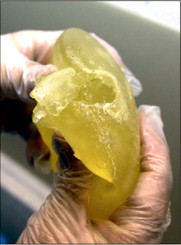 Hand holding PIP breast implant 